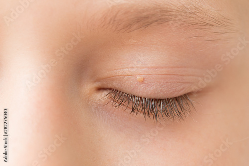 Close up of wart on eyelid. Young girl with papillomas on skin around eye, macro photo