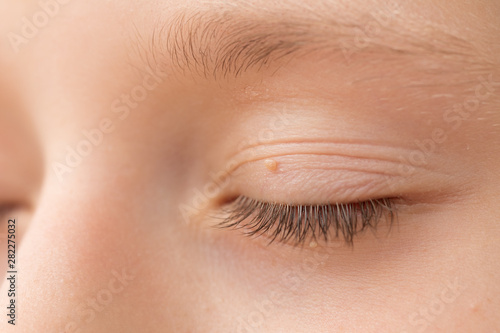 Close up of wart on eyelid. Young girl with papillomas on skin around eye, macro