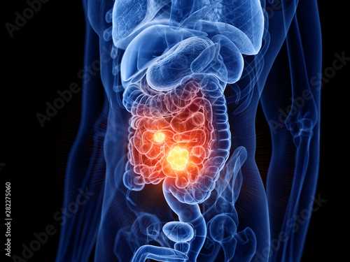 3d rendered medically accurate illustration of small intestine cancer