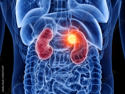 3d rendered medically accurate illustration of kidney cancer