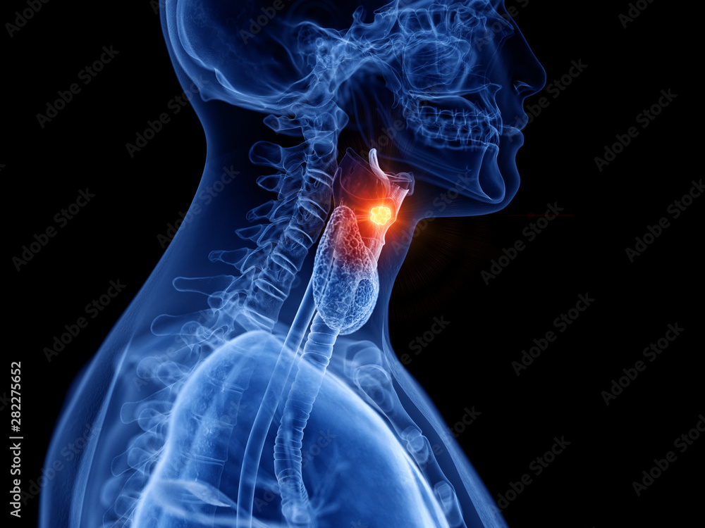 3d rendered medically accurate illustration of larynx cancer