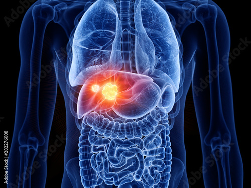 3d rendered medically accurate illustration of liver cancer