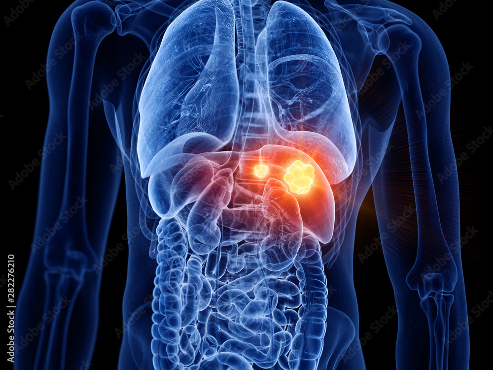 3d rendered medically accurate illustration of liver cancer 3d rendered medically accurate illustration of liver cancer