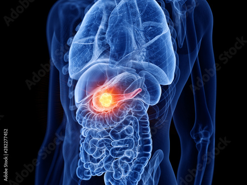 Foto 3d rendered medically accurate illustration of pancreas cancer