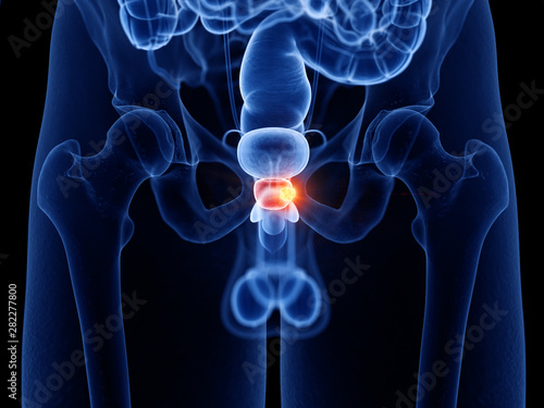 Fotografie 3d rendered medically accurate illustration of prostate cancer