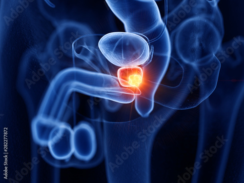 3d rendered medically accurate illustration of prostate cancer photo