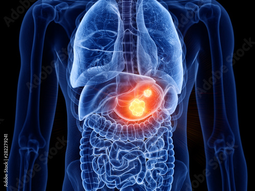 3d rendered medically accurate illustration of stomach cancer