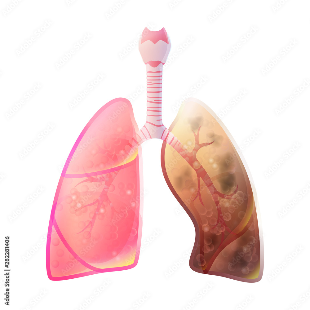 Fototapeta premium Vector illustration of lung cancer