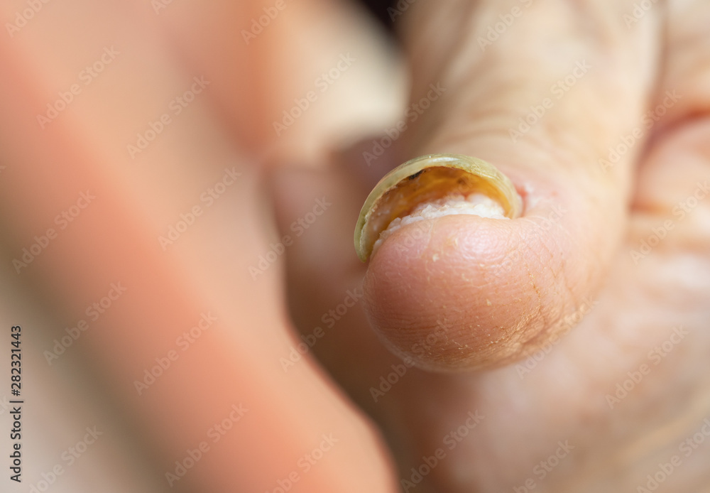 nail with advanced fungal disease nail with advanced fungal disease