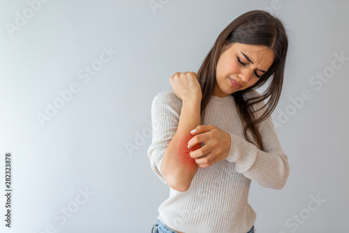 Health problem, skin diseases. Young woman scratching her itchy arm with allergy rash. Woman scratching her arm. Woman scratching arm indoors, space for text. Allergy symptoms photo