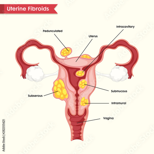 Scientific medical illustration of diseased vagina