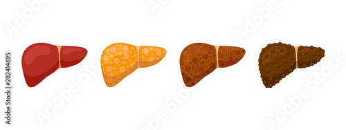 Stages human liver damage concept. Healthy liver steatosis fatty NASH fibrosis and cirrhosis. Vector cartoon reversible and irreversible condition illustration photo