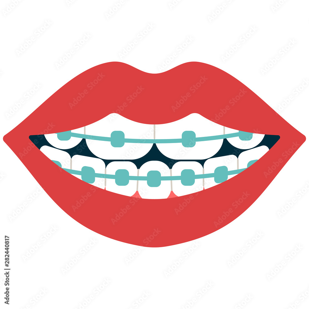 Dental braces vector cartoon illustration isolated on a white background. Dental braces vector cartoon illustration isolated on a white background.