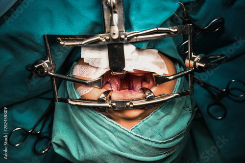Obraz na plátně Surgeon in hospital surgery for treatment about Cleft lip cleft palate in operating room at the hospital