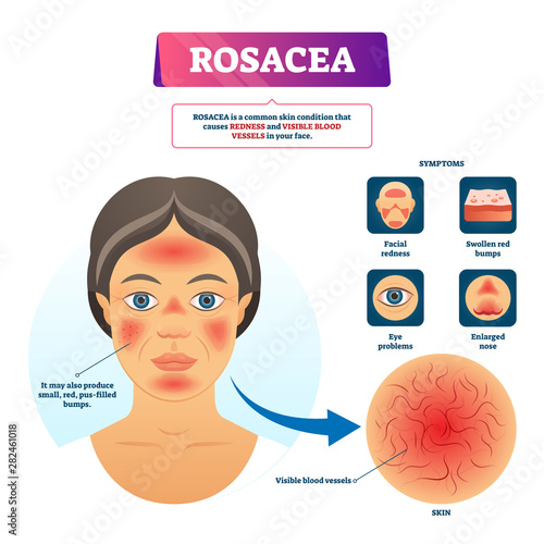 Rosacea vector illustration. Labeled red skin problem explanation scheme.