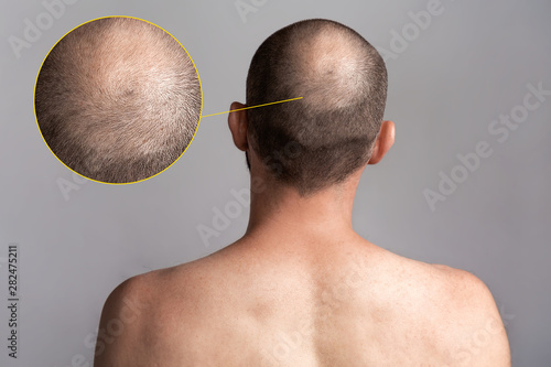 The concept of male alopecia and hair loss. Rear view of the man's head with a bald spot. Bare shoulders. Enlarged picture of the problem area photo