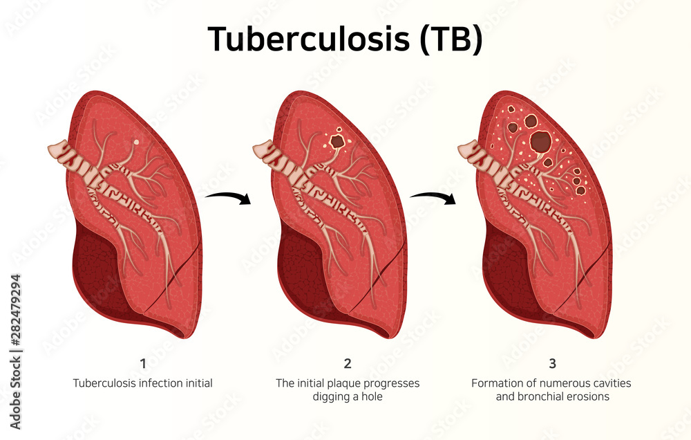 Lung Infected With Tuberculosis Latent Infection Cavitary Lung Infected With Tuberculosis Latent Infection Cavitary