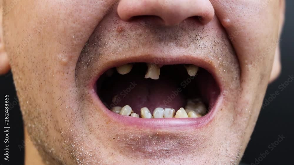 The man has rotten teeth, teeth fell out, yellow and black teeth hurt