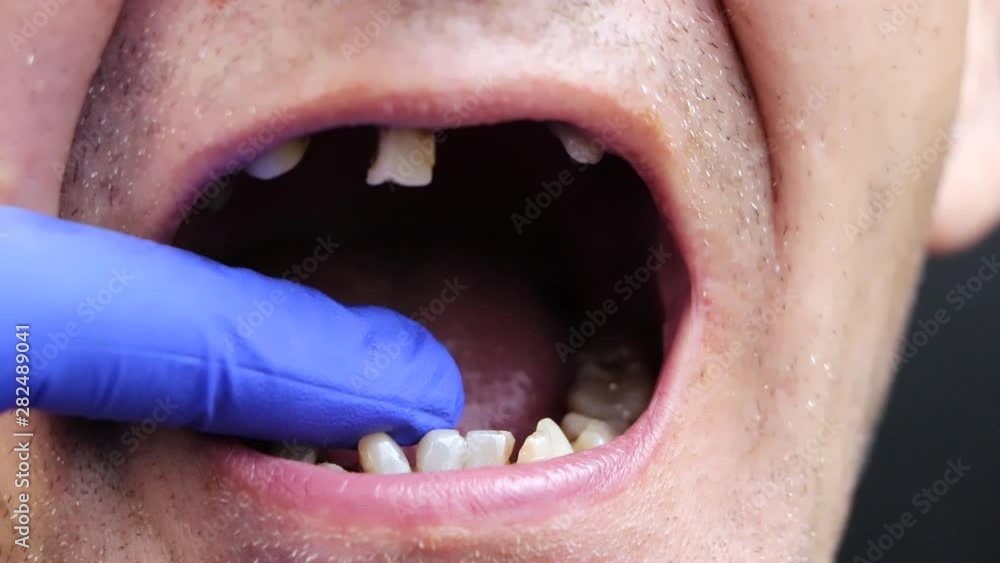 Video Stock The man has rotten teeth, teeth fell out, yellow and black