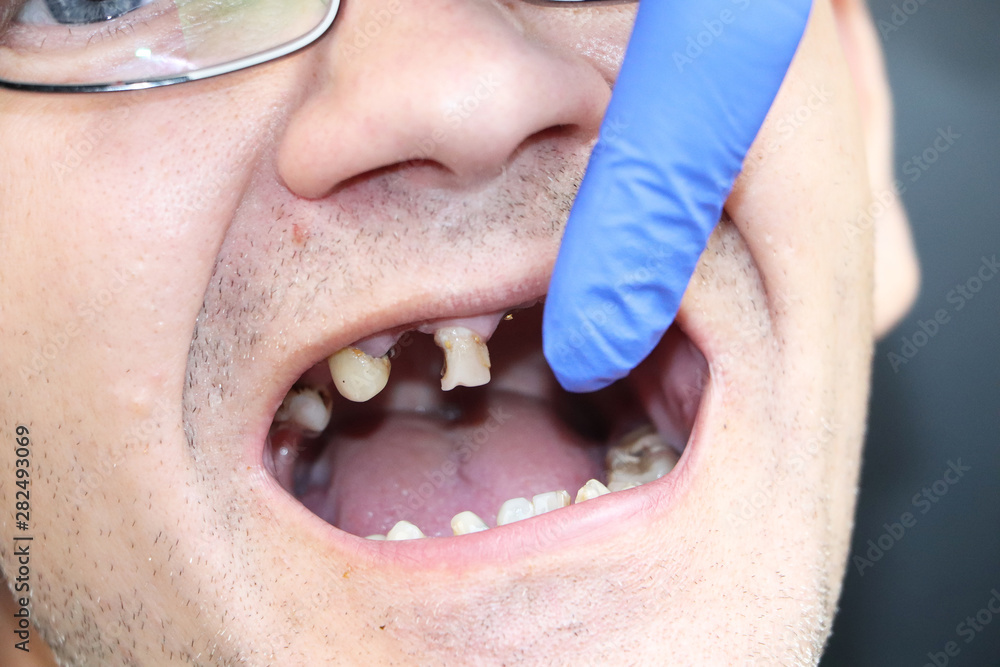 The man has rotten teeth, teeth fell out, yellow and black teeth hurt