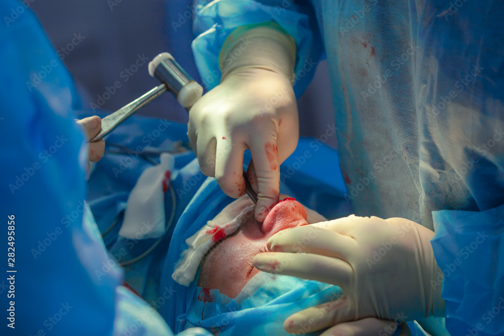 Surgeon and his assistant performing cosmetic surgery on nose in hospital operating room. Nose reshaping, augmentation. Rhinoplasty. Surgeon and his assistant performing cosmetic surgery on nose in hospital operating room. Nose reshaping, augmentation. Rhinoplasty.