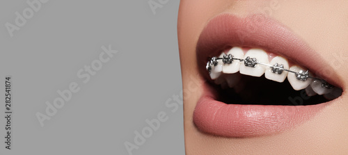Beautiful white teeth with braces. Dental care photo. Woman smile with ortodontic accessories. Orthodontics treatment photo