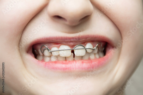 A girl with a removable orthodontic appliance. A child with a bracket on the teeth. Concept of pediatric dentistry  correcting the bite. Closeup  selective focus