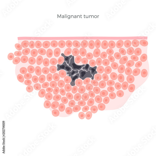 Vector isolated illustration of malignant tumor