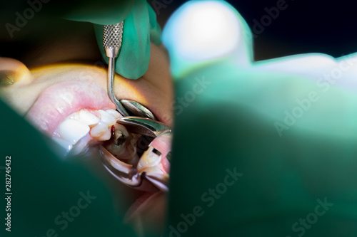 Close Up of Dentist Hand Using Dental Forceps to Extract a Decayed Tooth