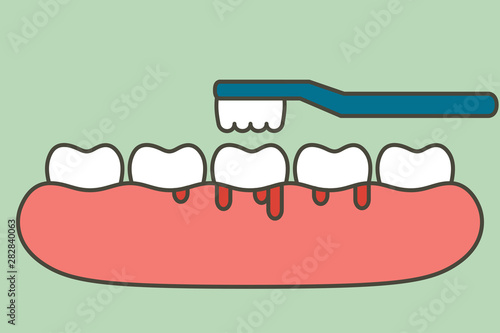 brushing teeth with bleeding on gum and tooth, gingivitis or scurvy concept - dental cartoon vector flat style