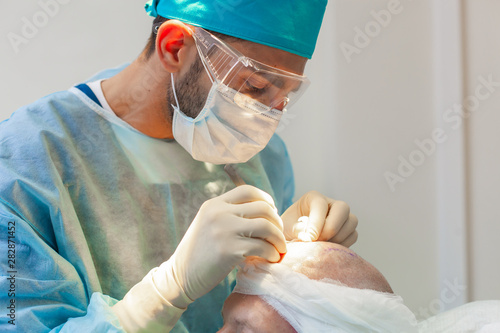 Baldness treatment. Hair transplant. Surgeons in the operating room carry out hair transplant surgery. Surgical technique that moves hair follicles from a part of the head.