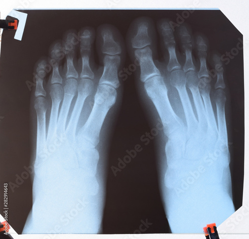 X-ray of toes. Foot on Xray. bone research photo