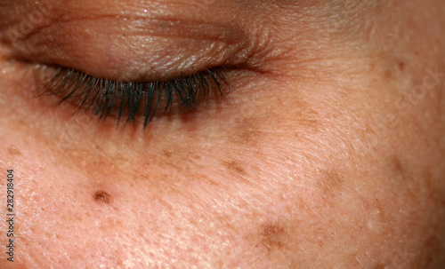 Brown spots on the face. Pigmentation on the skin. Brown age spots on the cheek.