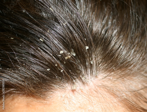 Dandruff on the hair. Hair disease seborrhea. Fatty Dandruff.