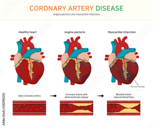coronary artery disease. (angina pectoris and myocardial infarction) photo