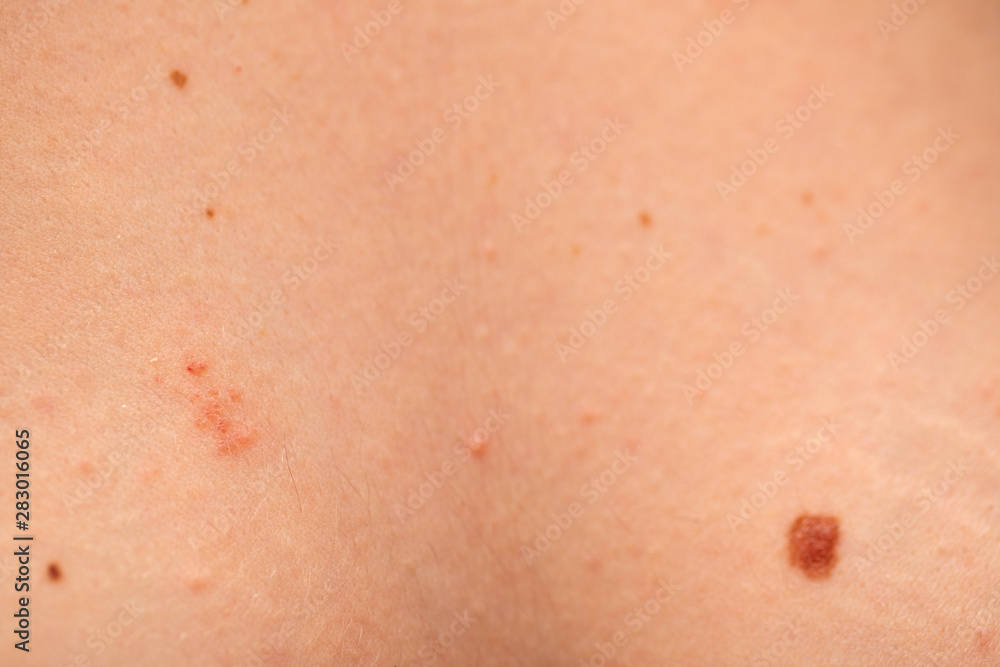  Dangerous nevus on skin - melanoma