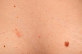  Dangerous nevus on skin - melanoma