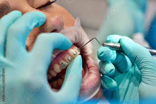 installation and removal of braces
