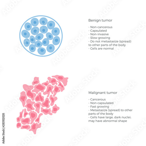 Vector  illustration of malignant and benign tumor