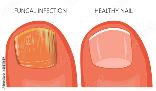Illustration of toe nail fungal infection. Used: gradient, transparency, blend mode.