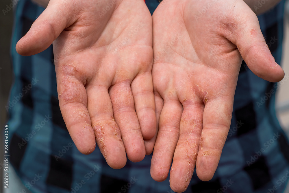 Dyshidrotic eczema, hands of patient. Concept of health care foto de ...