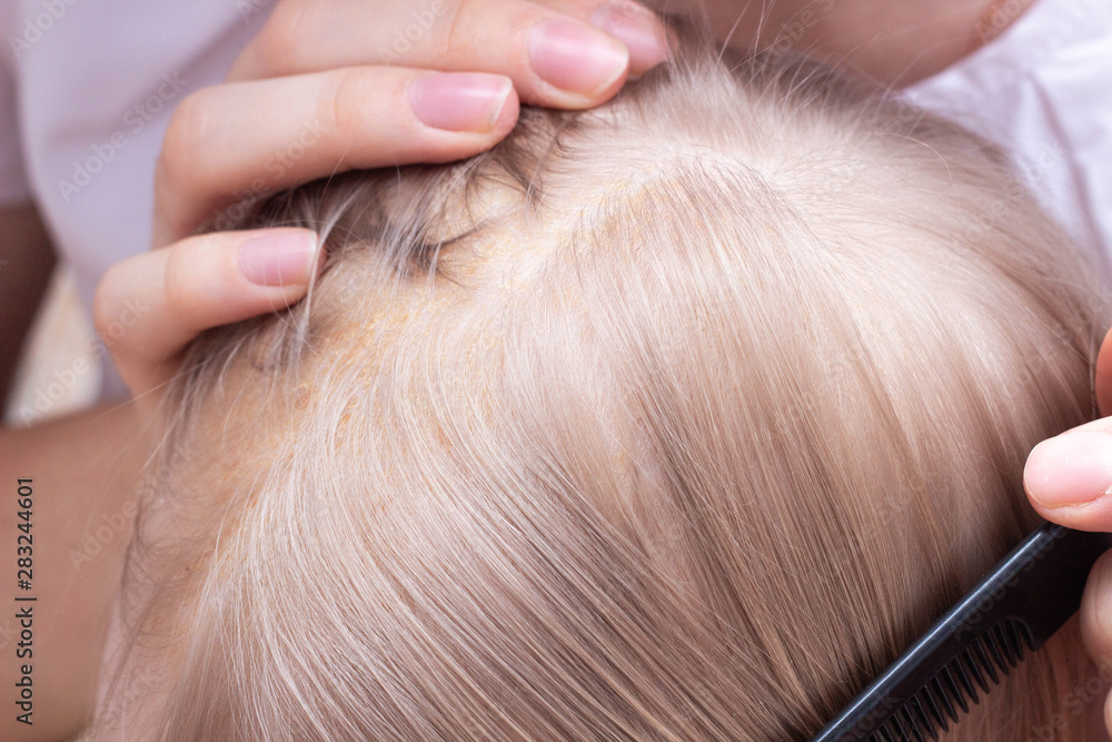 Obraz premium Mother combing seborrheic crust on baby s head, close-up, Seborrhoeic dermatitis, inflammatory