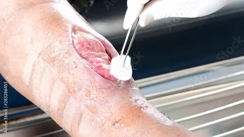 cleaning infected wound on leg 