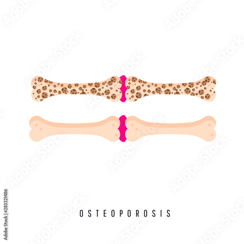 Medical problem of osteoporosis disease