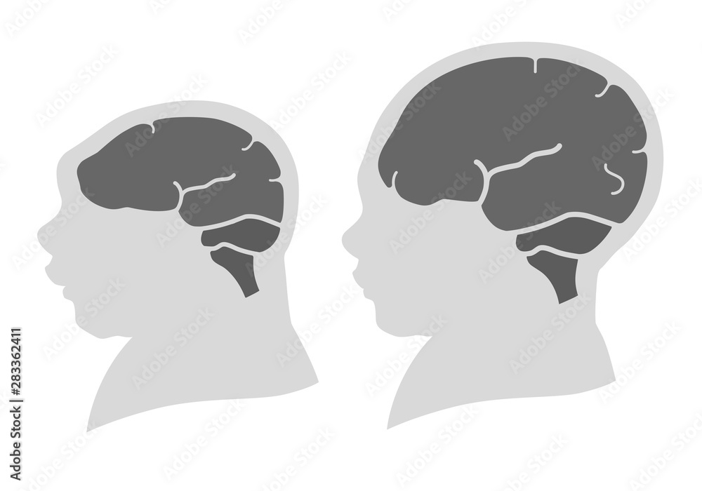 Silhouette image of the head and skull of a newborn child with a normal cranium and with microcephaly and severe microcephaly. Virus of Zika. Flat design