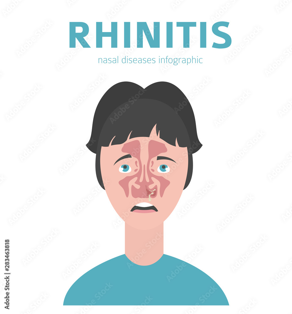 Nasal diseases. Rhinitis symptoms, treatment icon set. Medical infographic design