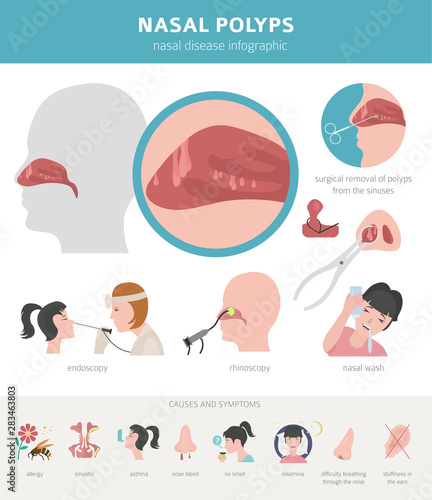 Nasal diseases. Nasal polyps causes, diagnosis and treatment medical infographic design