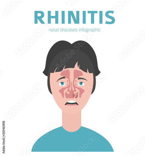 Nasal diseases. Rhinitis symptoms, treatment icon set. Medical infographic design