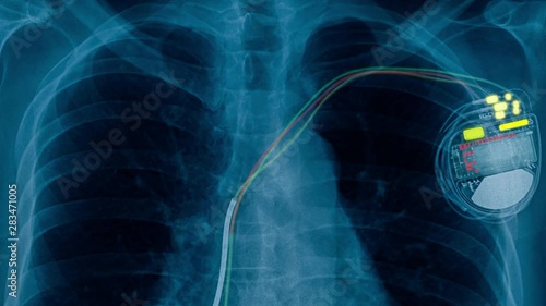 x-ray footage pacemaker cell and show electrical effect 