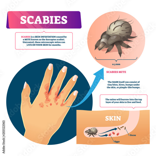 Scables vector illustration. Labeled educational skin infestation scheme.